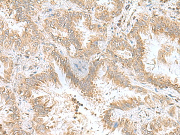 Immunohistochemistry of paraffin-embedded Human lung cancer tissue  using CPLX3 Polyclonal Antibody at dilution of 1:55(?200)