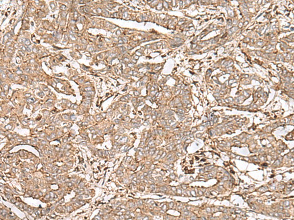 Immunohistochemistry of paraffin-embedded Human liver cancer tissue  using FAAP24 Polyclonal Antibody at dilution of 1:30(?200)