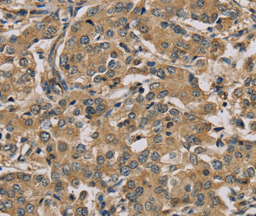Immunohistochemistry of paraffin-embedded Human liver cancer using MYL3 Polyclonal Antibody at dilution of 1:45