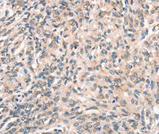 Immunohistochemistry of paraffin-embedded Human prostate cancer using DECR1 Polyclonal Antibody at dilution of 1:50