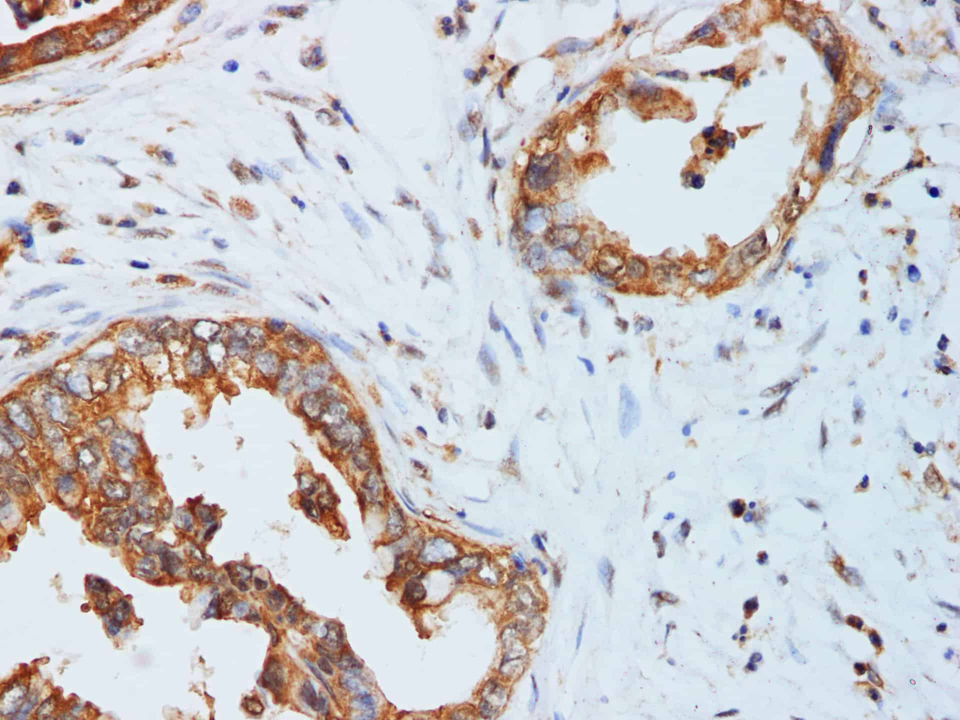 Immunohistochemistry of paraffin-embedded Pancreatic cancer using KLK10 Polyclonal Antibody at dilution of 1:200