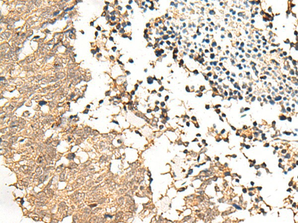 Immunohistochemistry of paraffin-embedded Human lung cancer tissue  using CHP1 Polyclonal Antibody at dilution of 1:25(?200)