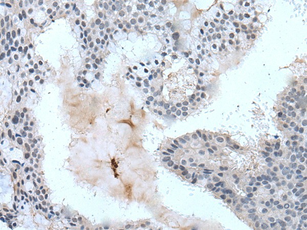 Immunohistochemistry of paraffin-embedded Human breast cancer tissue  using ZBTB3 Polyclonal Antibody at dilution of 1:55(?200)