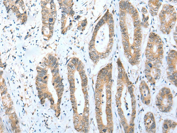 Immunohistochemistry of paraffin-embedded Human gastric cancer tissue  using ACBD4 Polyclonal Antibody at dilution of 1:30(?200)