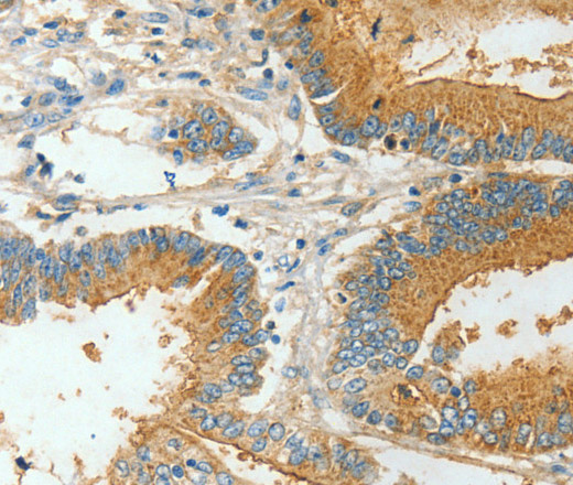 Immunohistochemistry of paraffin-embedded Human colon cancer using BAAT Polyclonal Antibody at dilution of 1:30