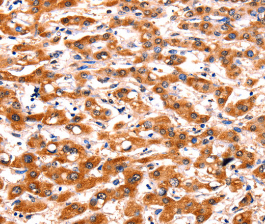 Immunohistochemistry of paraffin-embedded Human liver cancer tissue using FBLN1 Polyclonal Antibody at dilution 1:47