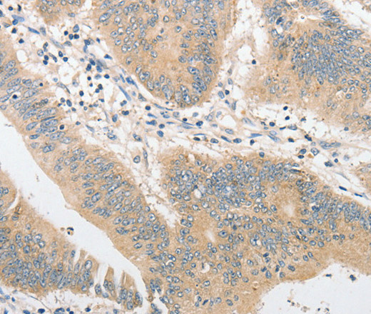 Immunohistochemistry of paraffin-embedded Human colon cancer tissue using CD284 Polyclonal Antibody at dilution 1:40