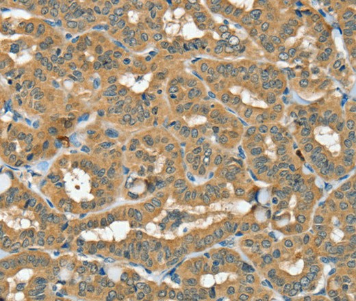 Immunohistochemistry of paraffin-embedded Human thyroid cancer using SEC14L2 Polyclonal Antibody at dilution of 1:40