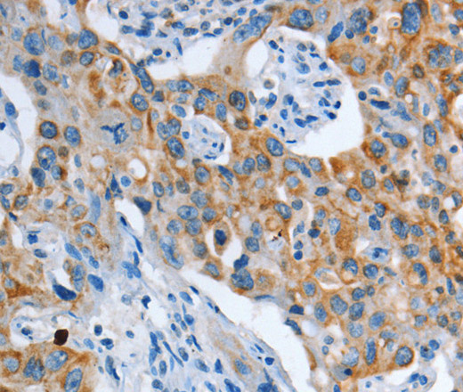 Immunohistochemistry of paraffin-embedded Human lung cancer tissue using ASL Polyclonal Antibody at dilution 1:35