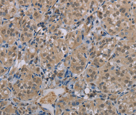 Immunohistochemistry of paraffin-embedded Human thyroid cancer tissue using MGLL Polyclonal Antibody at dilution 1:40