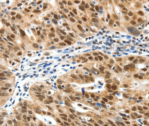 Immunohistochemistry of paraffin-embedded Human ovarian cancer tissue using SP1 Polyclonal Antibody at dilution 1:30