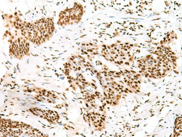 Immunohistochemistry of paraffin-embedded Human esophagus cancer tissue  using TCOF1 Polyclonal Antibody at dilution of 1:50(?200)