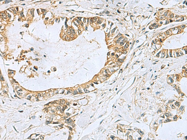 Immunohistochemistry of paraffin-embedded Human gastric cancer tissue  using TUBD1 Polyclonal Antibody at dilution of 1:70(?200)