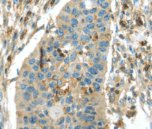 Immunohistochemistry of paraffin-embedded Human breast cancer tissue using RIPK4 Polyclonal Antibody at dilution 1:40