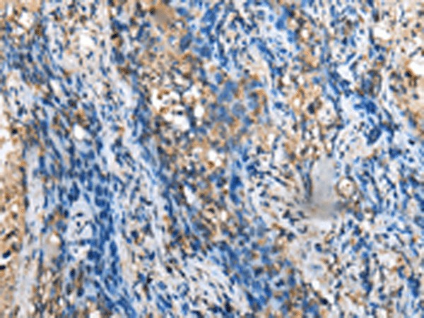 Immunohistochemistry of paraffin-embedded Human lung cancer tissue  using MOB4 Polyclonal Antibody at dilution of 1:35(?200)