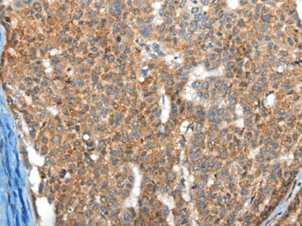 Immunohistochemistry of paraffin-embedded Human liver cancer tissue  using FTL Polyclonal Antibody at dilution of 1:30(?200)