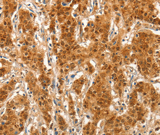 Immunohistochemistry of paraffin-embedded Human gastric cancer tissue using COL4A3BP Polyclonal Antibody at dilution 1:50