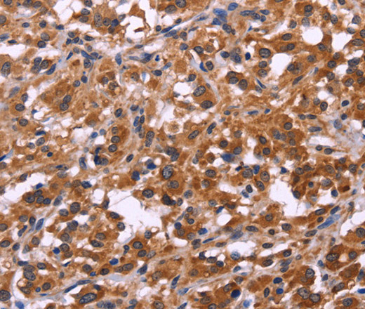 Immunohistochemistry of paraffin-embedded Human thyroid cancer tissue using SPATA7 Polyclonal Antibody at dilution 1:30