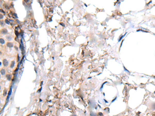 Immunohistochemistry of paraffin-embedded Human breast cancer tissue  using WRN Polyclonal Antibody at dilution of 1:55(?200)