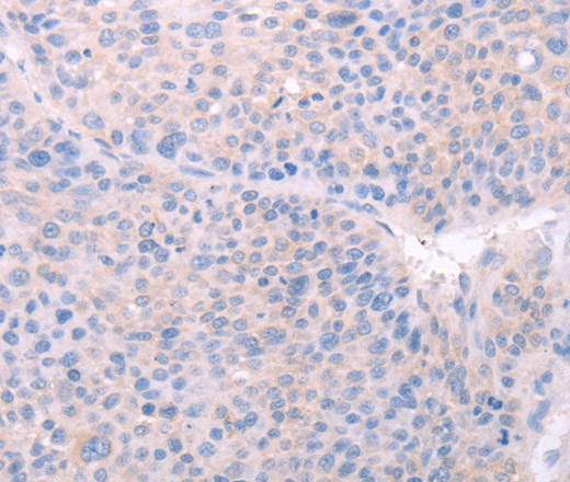 Immunohistochemistry of paraffin-embedded Human liver cancer using SPATA6 Polyclonal Antibody at dilution of 1:40