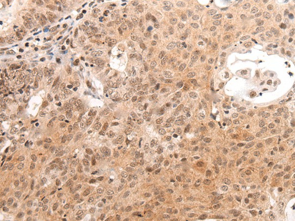 Immunohistochemistry of paraffin-embedded Human ovarian cancer tissue  using C14orf169 Polyclonal Antibody at dilution of 1:45(?200)