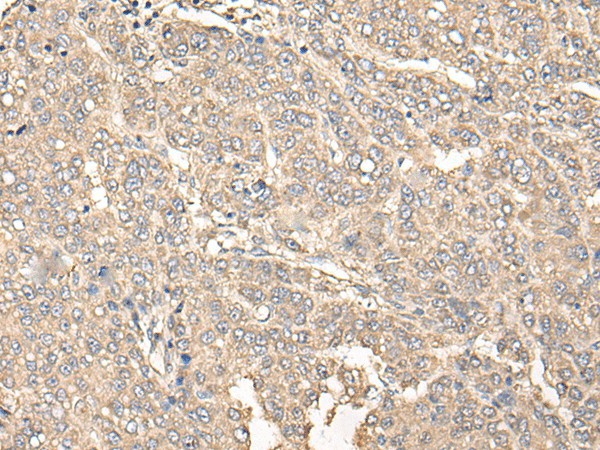 Immunohistochemistry of paraffin-embedded Human liver cancer tissue  using C12orf40 Polyclonal Antibody at dilution of 1:50(?200)