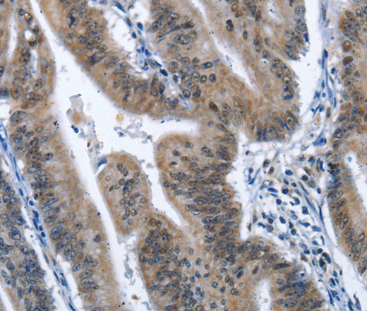 Immunohistochemistry of paraffin-embedded Human colon cancer tissue using CADM3 Polyclonal Antibody at dilution 1:40