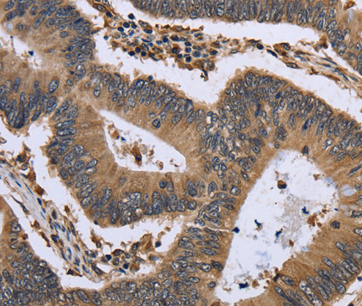 Immunohistochemistry of paraffin-embedded Human colon cancer tissue using GADD45B Polyclonal Antibody at dilution 1:30