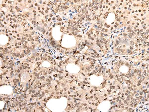 Immunohistochemistry of paraffin-embedded Human ovarian cancer tissue  using ZSCAN12 Polyclonal Antibody at dilution of 1:40(?200)