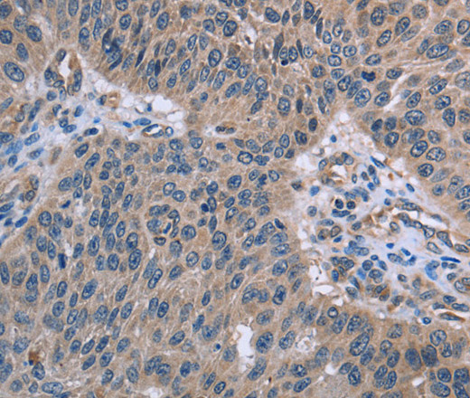 Immunohistochemistry of paraffin-embedded Human lung cancer using p53RFP Polyclonal Antibody at dilution of 1:50