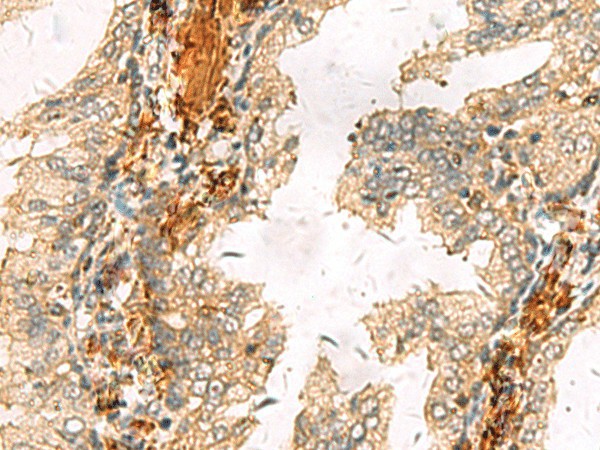 Immunohistochemistry of paraffin-embedded Human prost at e cancer tissue  using ACTC1 Polyclonal Antibody at dilution of 1:65(?200)