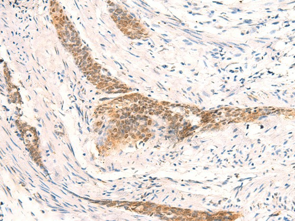 Immunohistochemistry of paraffin-embedded Human esophagus cancer tissue  using HSPA4L Polyclonal Antibody at dilution of 1:30(?200)