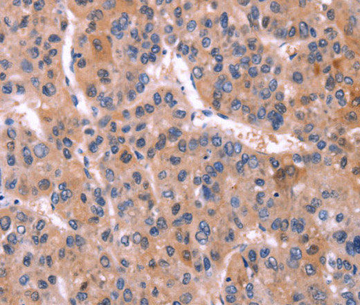 Immunohistochemistry of paraffin-embedded Human liver cancer using CD269 Polyclonal Antibody at dilution of 1:30