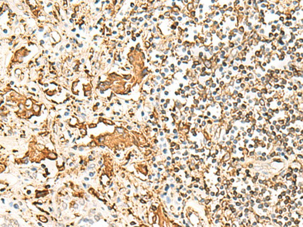 Immunohistochemistry of paraffin-embedded Human prost at e cancer tissue  using HLA-DRB1 Polyclonal Antibody at dilution of 1:75(?200)