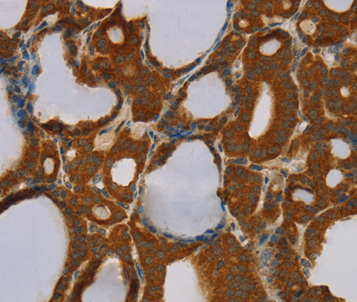 Immunohistochemistry of paraffin-embedded Human thyroid cancer tissue using PARP3 Polyclonal Antibody at dilution 1:40