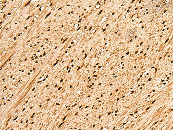 Immunohistochemistry of paraffin-embedded Human colorectal cancer tissue  using PNRC2 Polyclonal Antibody at dilution of 1:50(?200)