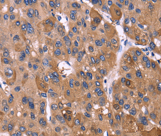 Immunohistochemistry of paraffin-embedded Human liver cancer tissue using KIR2DL1/3/4/S4 Polyclonal Antibody at dilution 1:40