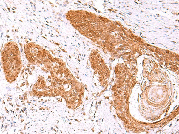 Immunohistochemistry of paraffin-embedded Human esophagus cancer tissue  using FDPS Polyclonal Antibody at dilution of 1:60(?200)