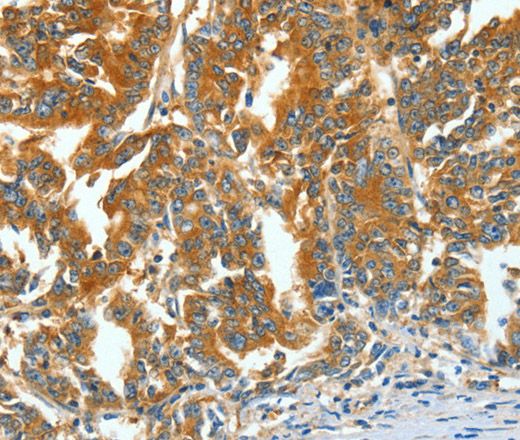 Immunohistochemistry of paraffin-embedded Human gastric cancer using ASNS Polyclonal Antibody at dilution of 1:60