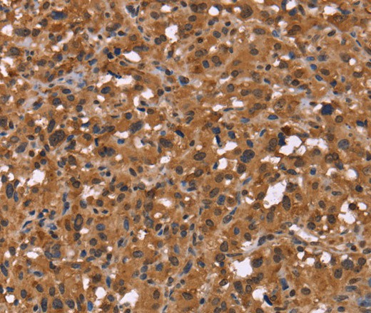 Immunohistochemistry of paraffin-embedded Human thyroid cancer using HDLBP Polyclonal Antibody at dilution of 1:50