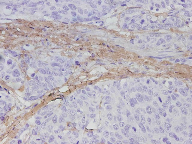 Immunohistochemistry of paraffin-embedded Human stomach cancer tissue using COL1A1 Polyclonal Antibody at dilution of 1:1700(?400)