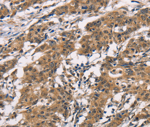 Immunohistochemistry of paraffin-embedded Human gasrtic cancer tissue using ADGRB1 Polyclonal Antibody at dilution 1:40