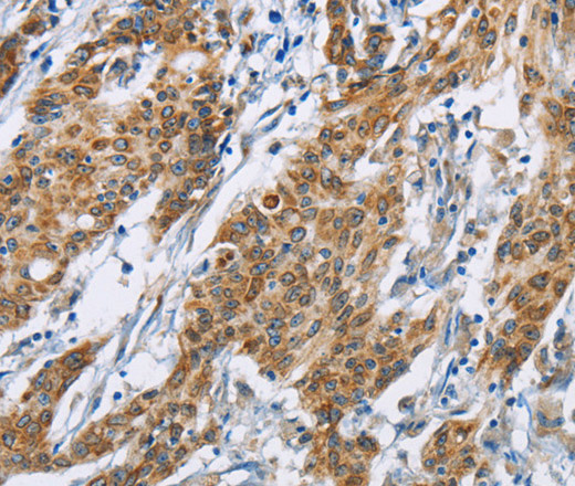 Immunohistochemistry of paraffin-embedded Human gastric cancer tissue using CD272 Polyclonal Antibody at dilution 1:30