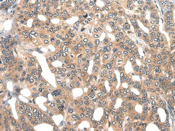 Immunohistochemistry of paraffin-embedded Human liver cancer tissue  using GPR55 Polyclonal Antibody at dilution of 1:40(?200)