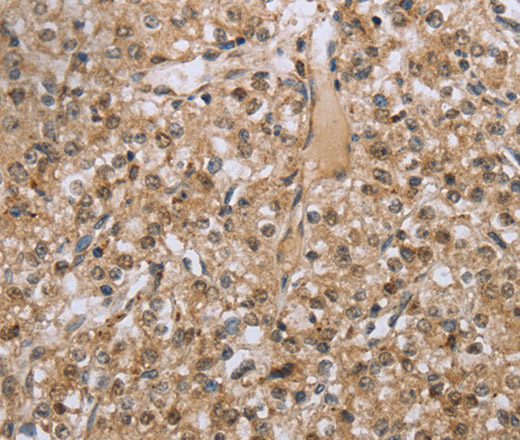 Immunohistochemistry of paraffin-embedded Human prostate cancer tissue using RAB39B Polyclonal Antibody at dilution 1:45