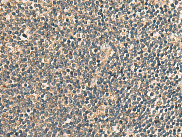 Immunohistochemistry of paraffin-embedded Human tonsil tissue  using PRKRA Polyclonal Antibody at dilution of 1:65(?200)