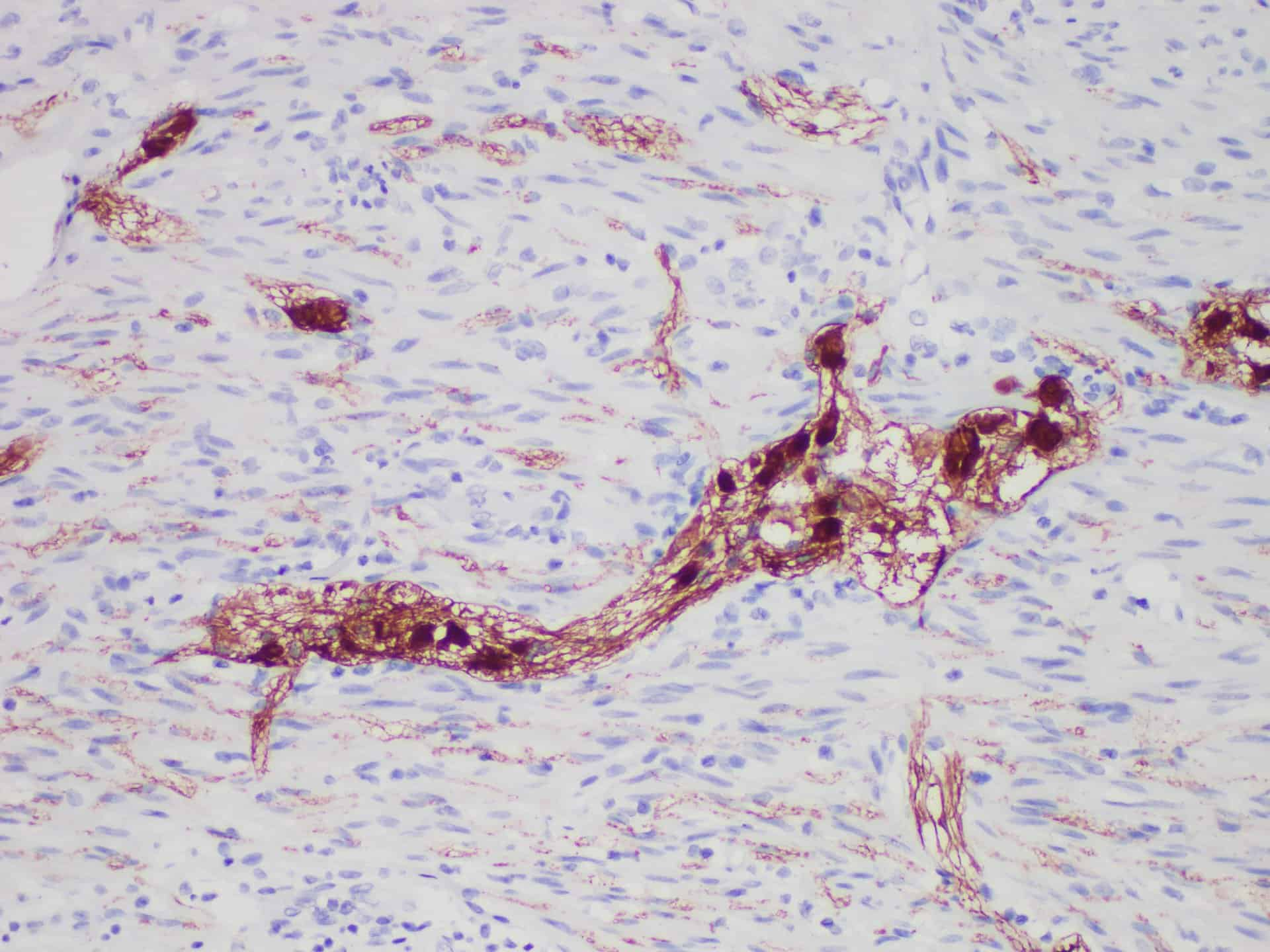 Immunohistochemistry of paraffinembedded Human appendix tissue with Calretinin(CR) Monoclonal Antibody(Antigen repaired by EDTA).