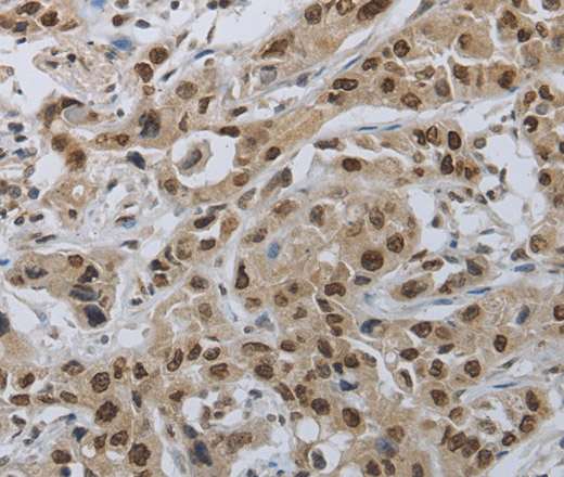 Immunohistochemistry of paraffin-embedded Human lung cancer using PRKAR1B Polyclonal Antibody at dilution of 1:70