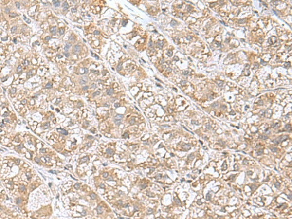 Immunohistochemistry of paraffin-embedded Human liver cancer tissue  using EIF1AY Polyclonal Antibody at dilution of 1:55(?200)