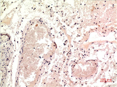 Immunohistochemistry of paraffin-embedded Human colon carcinoma tissue using gamma Tubulin Monoclonal Antibody at dilution of 1:200.